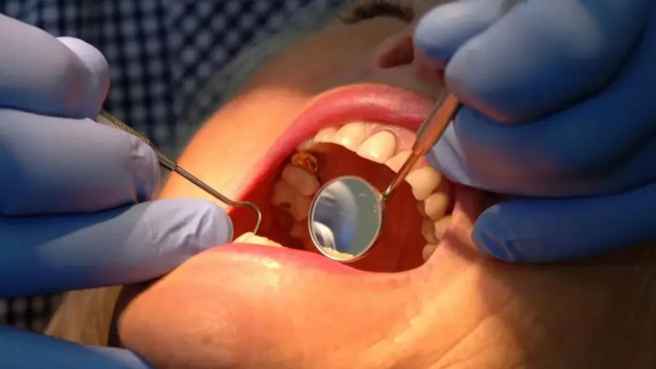 dis minesini onaran yeni jel curuklerin sonu mu geliyor LDBP2Dhl.jpg